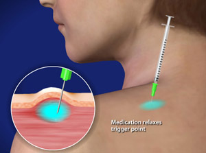 https://www.delightmedical.com/wp-content/uploads/2017/02/trigger-point-injections-los-angeles.jpg
