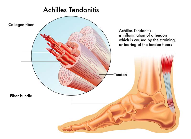 severe pain in achilles tendon