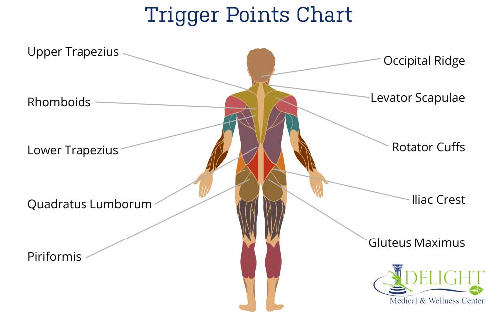 Trigger Points and Referral Pain Delight Medical and Wellness Center
